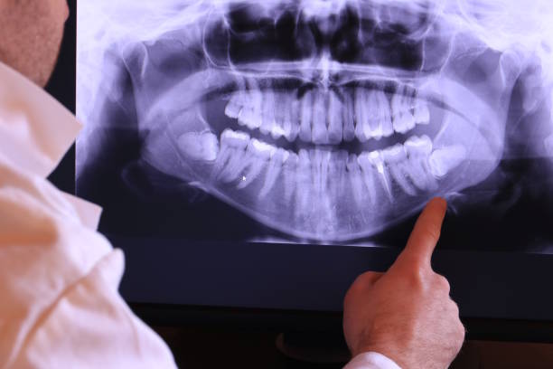 Best Emergency Tooth Extraction in Fort Denaud, FL